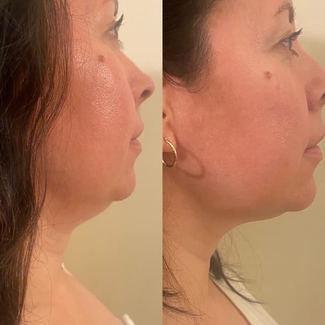 Cryo Under Chin Contour at Vanity Private Studio in Burbank, CA